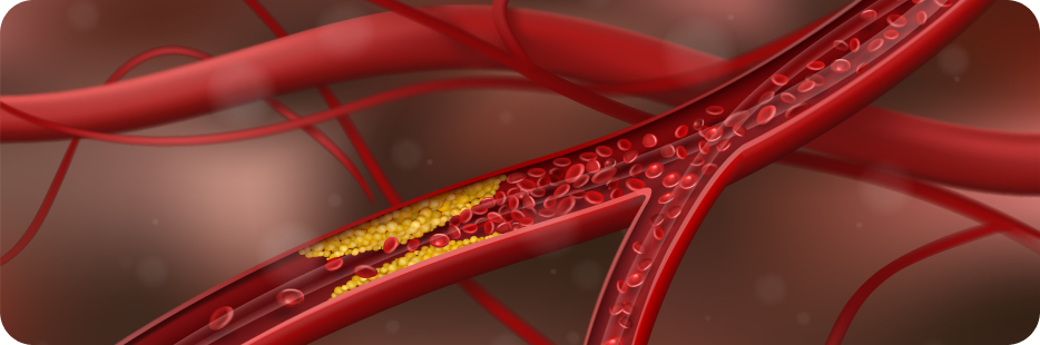 От атеросклеротической бляшки до ишемии: как развивается инфаркт миокарда